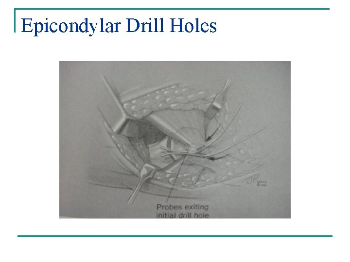 Epicondylar Drill Holes 