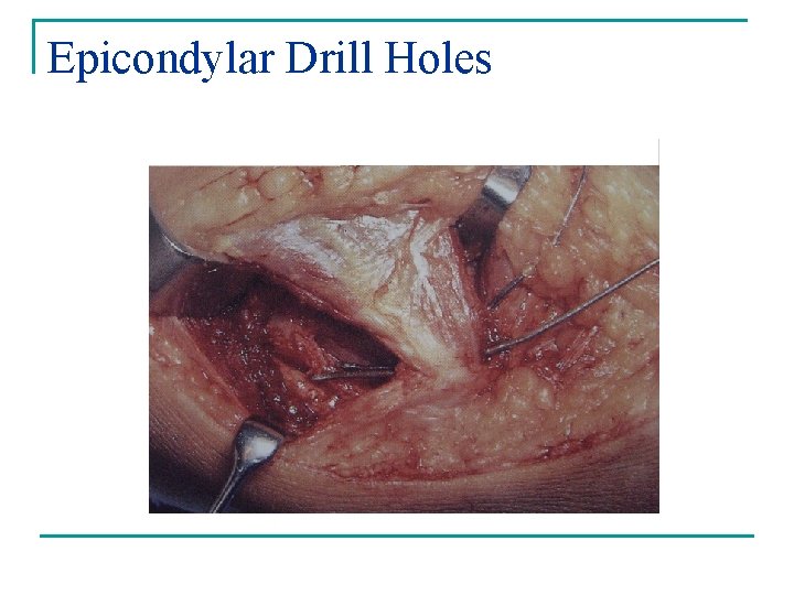 Epicondylar Drill Holes 