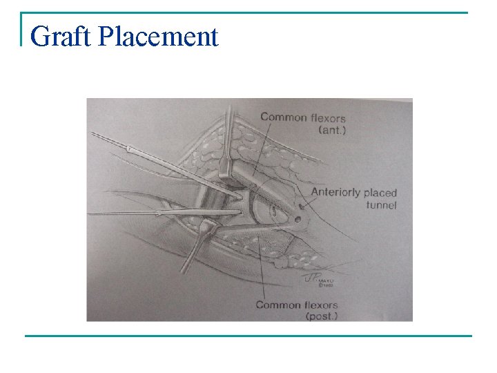 Graft Placement 