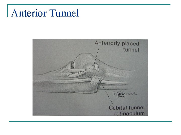 Anterior Tunnel 