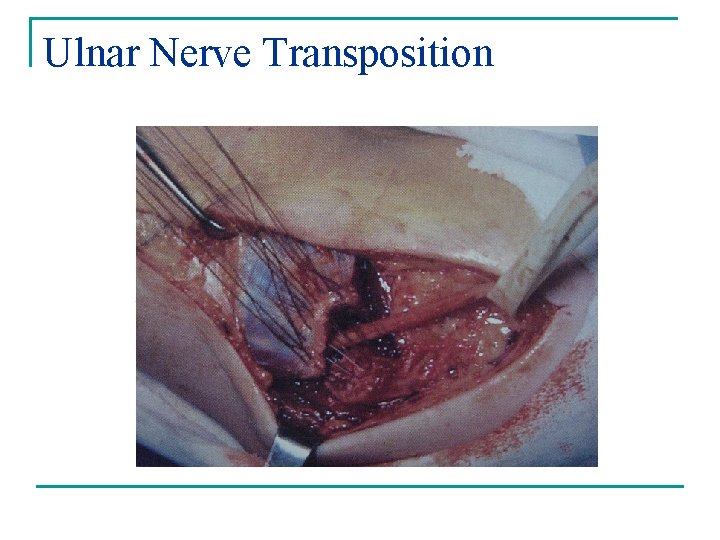 Ulnar Nerve Transposition 