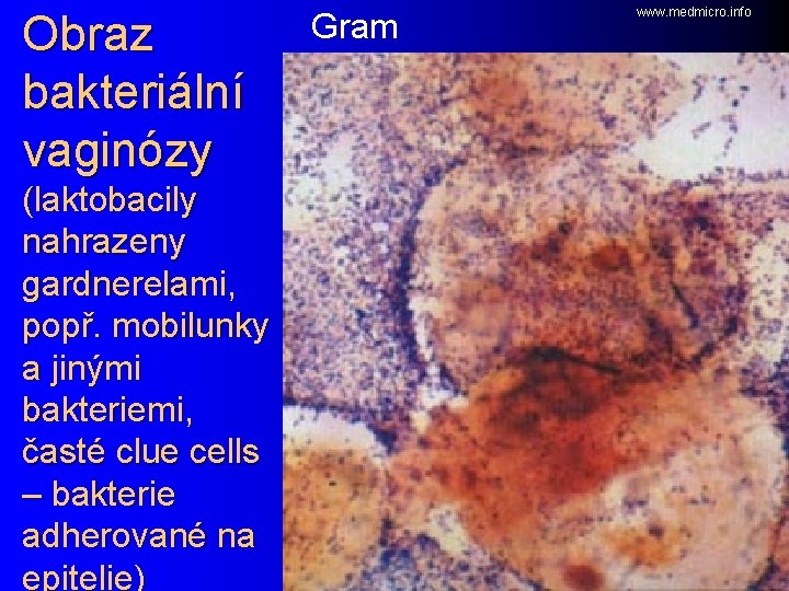 Obraz bakteriální vaginózy (laktobacily nahrazeny gardnerelami, popř. mobilunky a jinými bakteriemi, časté clue cells