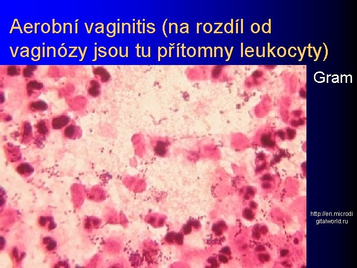 Aerobní vaginitis (na rozdíl od vaginózy jsou tu přítomny leukocyty) Gram http: //en. microdi