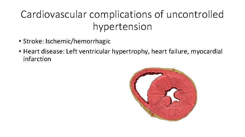 Cardiovascular complications of uncontrolled hypertension • Stroke: Ischemic/hemorrhagic • Heart disease: Left ventricular hypertrophy,