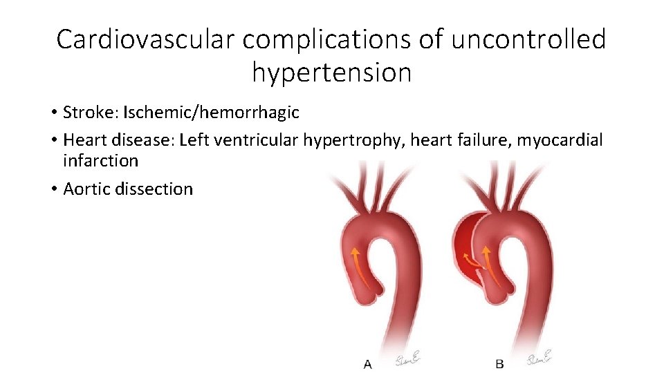 Cardiovascular complications of uncontrolled hypertension • Stroke: Ischemic/hemorrhagic • Heart disease: Left ventricular hypertrophy,