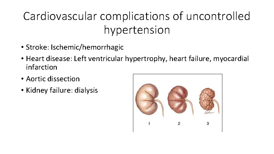 Cardiovascular complications of uncontrolled hypertension • Stroke: Ischemic/hemorrhagic • Heart disease: Left ventricular hypertrophy,