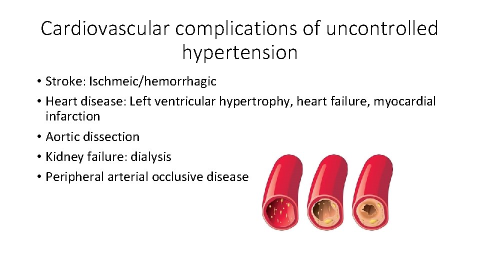 Cardiovascular complications of uncontrolled hypertension • Stroke: Ischmeic/hemorrhagic • Heart disease: Left ventricular hypertrophy,