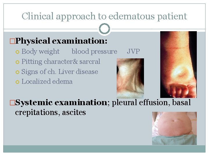 Clinical approach to edematous patient �Physical examination: Body weight blood pressure JVP Pitting character&