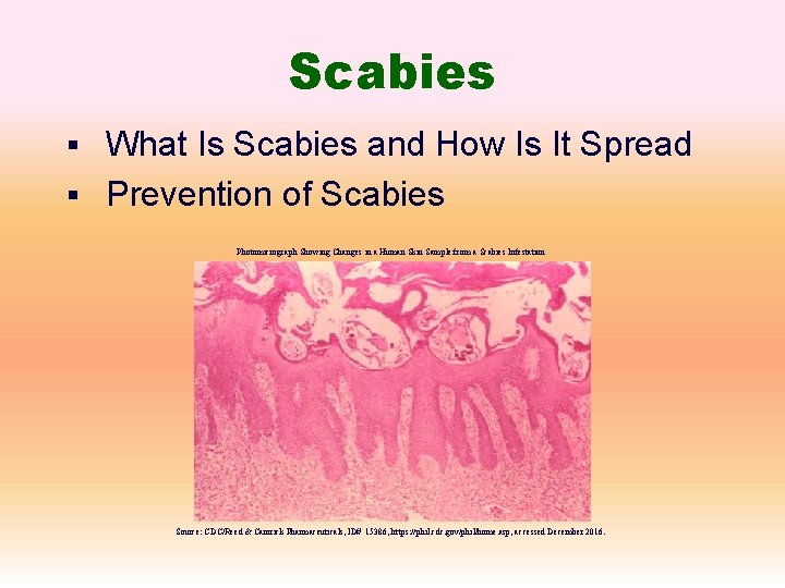 Scabies § What Is Scabies and How Is It Spread § Prevention of Scabies