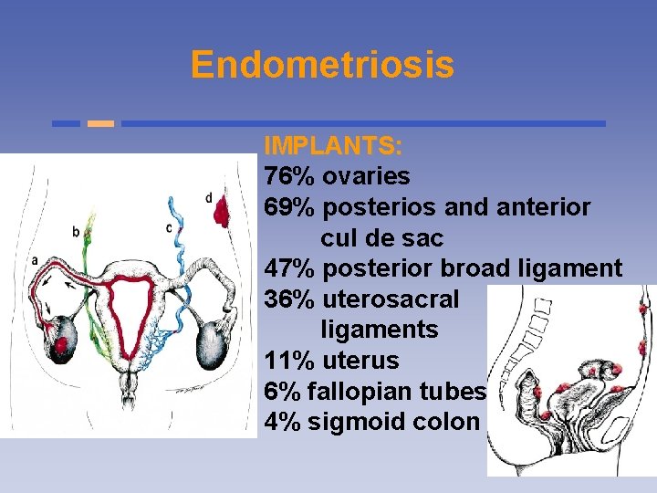 Endometriosis IMPLANTS: 76% ovaries 69% posterios and anterior cul de sac 47% posterior broad