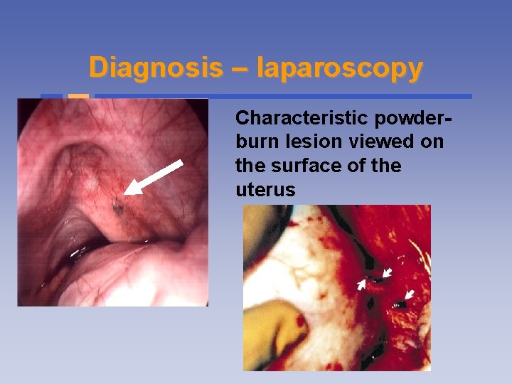 Diagnosis – laparoscopy Characteristic powderburn lesion viewed on the surface of the uterus 