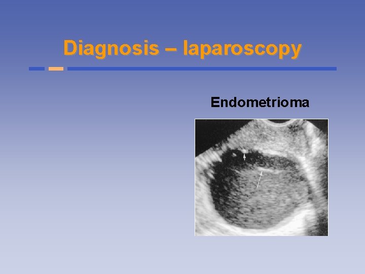 Diagnosis – laparoscopy Endometrioma 