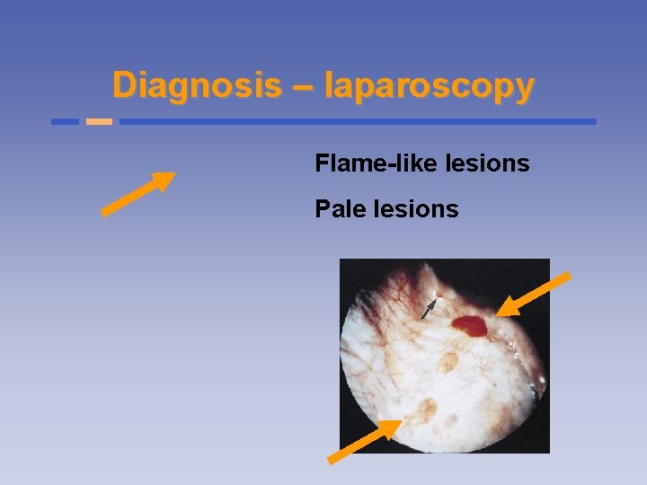 Diagnosis – laparoscopy Flame-like lesions Pale lesions 