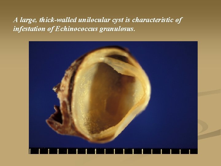 A large, thick-walled unilocular cyst is characteristic of infestation of Echinococcus granulosus. 