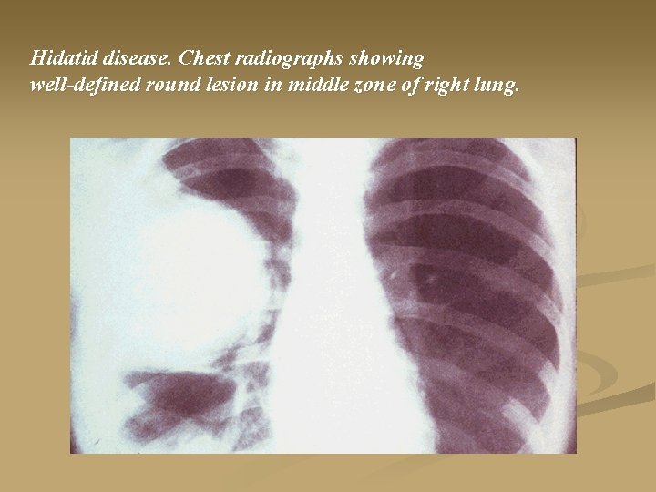 Hidatid disease. Chest radiographs showing well-defined round lesion in middle zone of right lung.