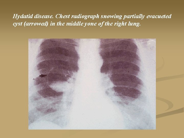 Hydatid disease. Chest radiograph snowing partially evacueted cyst (arrowed) in the middle yone of