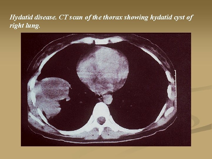 Hydatid disease. CT scan of the thorax showing hydatid cyst of right lung. 