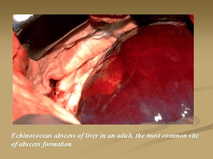 Echinococcus abscess of liver in an adult, the most common site of abscess formation.