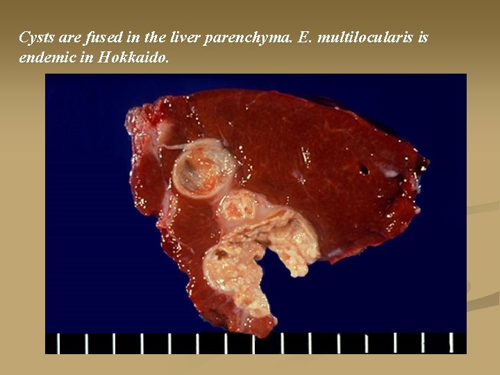 Cysts are fused in the liver parenchyma. E. multilocularis is endemic in Hokkaido. 