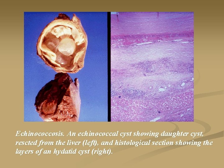 Echinococcosis. An echinococcal cyst showing daughter cyst, rescted from the liver (left), and histological