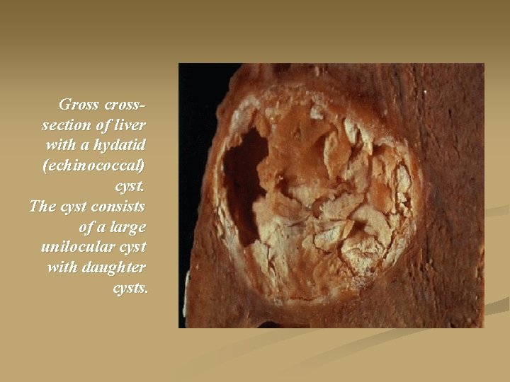 Gross crosssection of liver with a hydatid (echinococcal) cyst. The cyst consists of a