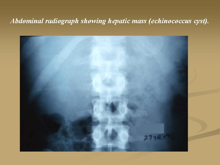 Abdominal radiograph showing hepatic mass (echinococcus cyst). 