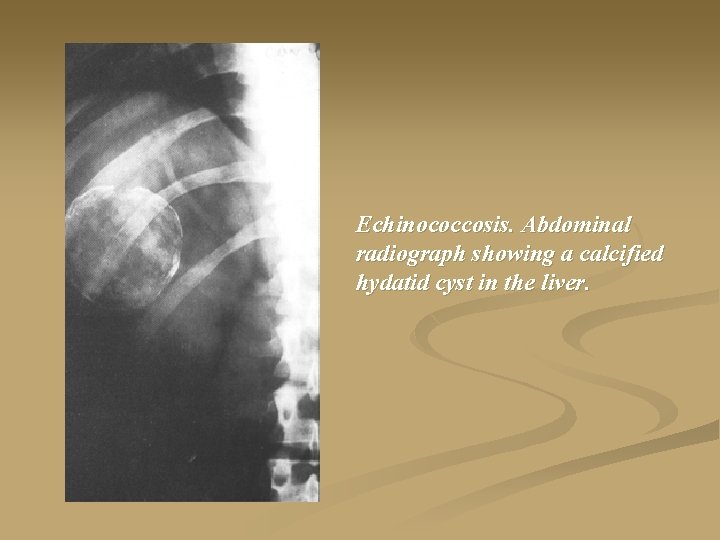 Echinococcosis. Abdominal radiograph showing a calcified hydatid cyst in the liver. 