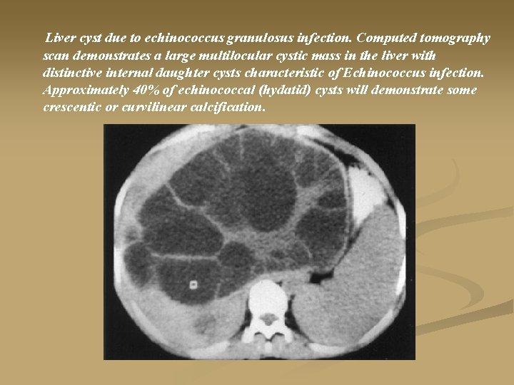  Liver cyst due to echinococcus granulosus infection. Computed tomography scan demonstrates a large