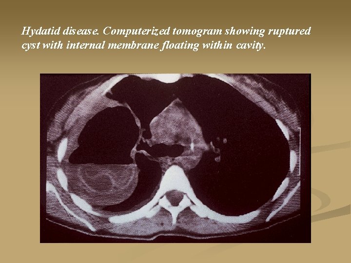 Hydatid disease. Computerized tomogram showing ruptured cyst with internal membrane floating within cavity. 