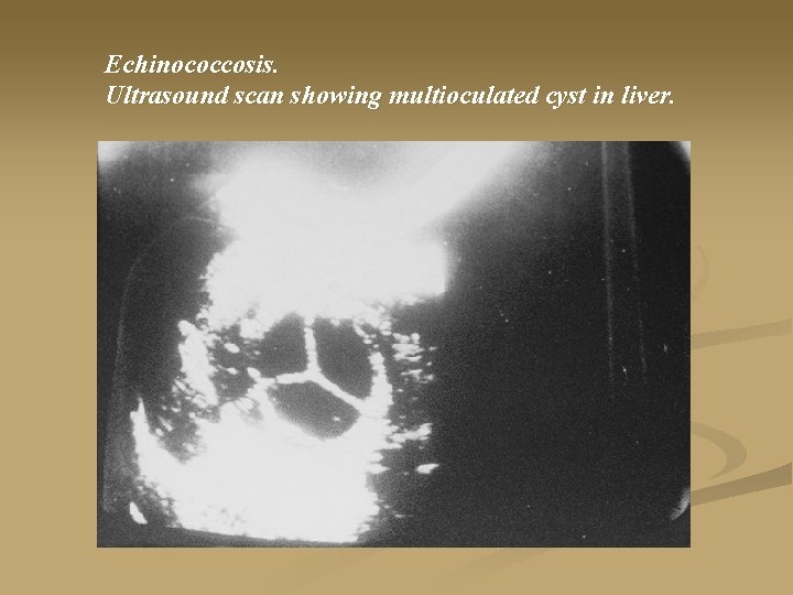 Echinococcosis. Ultrasound scan showing multioculated cyst in liver. 