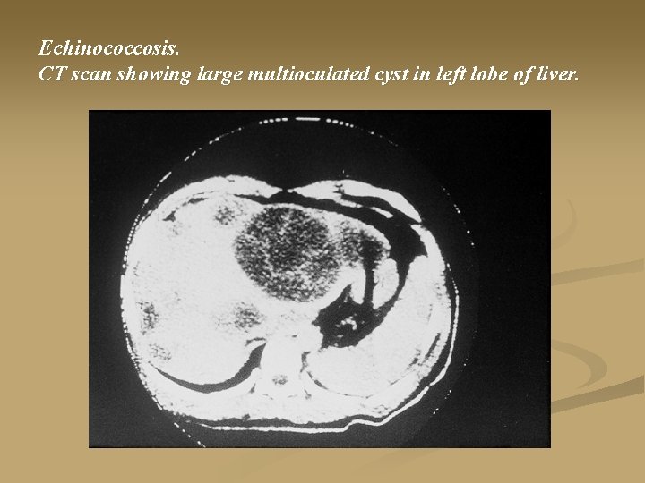 Echinococcosis. CT scan showing large multioculated cyst in left lobe of liver. 
