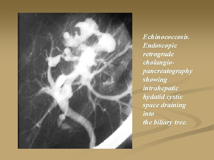 Echinococcosis. Endoscopic retrograde cholangiopancreatography showing intrahepatic hydatid cystic space draining into the biliary tree.