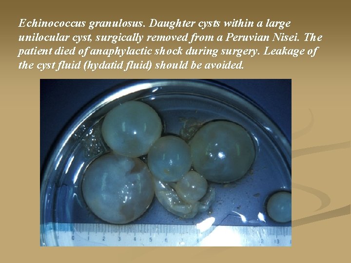 Echinococcus granulosus. Daughter cysts within a large unilocular cyst, surgically removed from a Peruvian