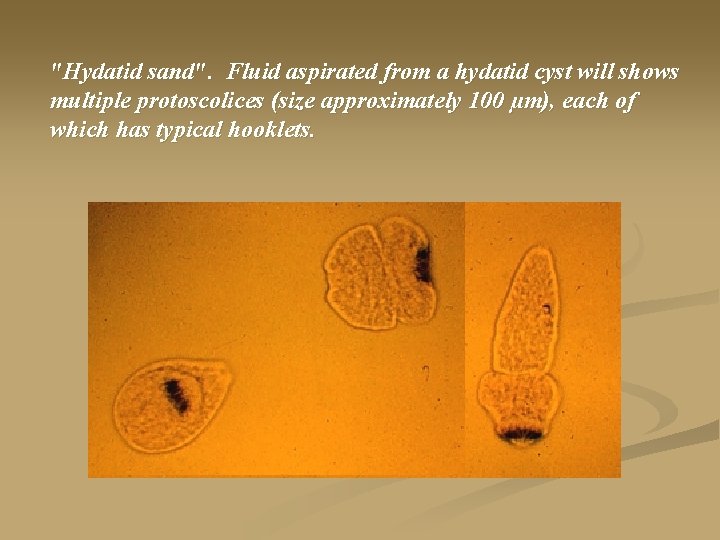"Hydatid sand". Fluid aspirated from a hydatid cyst will shows multiple protoscolices (size approximately