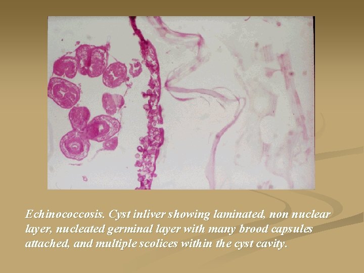 Echinococcosis. Cyst inliver showing laminated, non nuclear layer, nucleated germinal layer with many brood