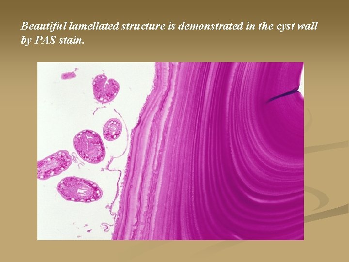 Beautiful lamellated structure is demonstrated in the cyst wall by PAS stain. 