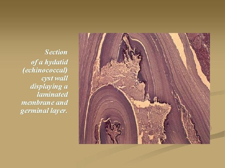 Section of a hydatid (echinococcal) cyst wall displaying a laminated membrane and germinal layer.