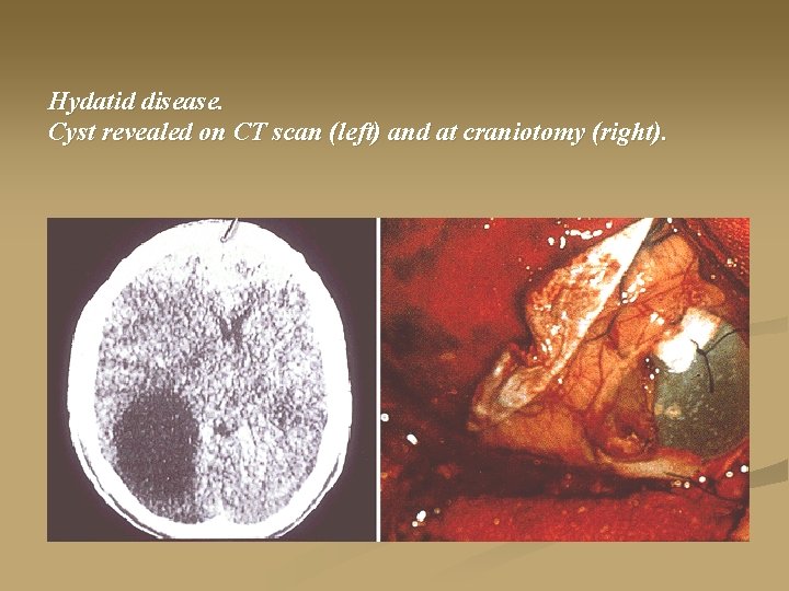 Hydatid disease. Cyst revealed on CT scan (left) and at craniotomy (right). 