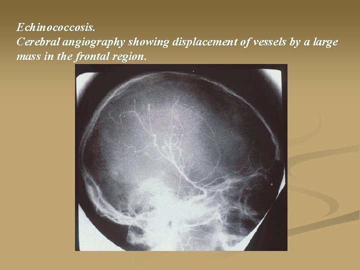 Echinococcosis. Cerebral angiography showing displacement of vessels by a large mass in the frontal