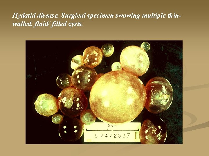 Hydatid disease. Surgical specimen swowing multiple thinwalled, fluid/ filled cysts. 