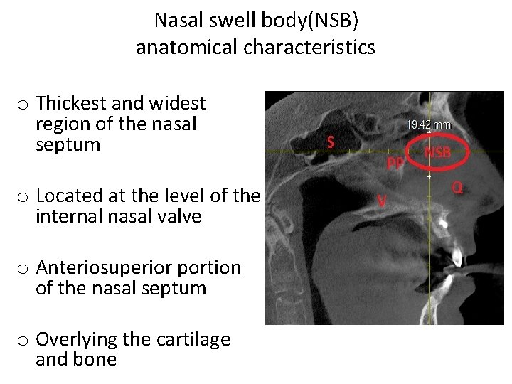 Nasal swell body(NSB) anatomical characteristics o Thickest and widest region of the nasal septum