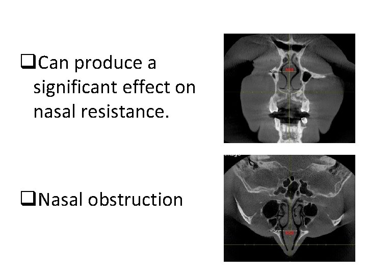 q. Can produce a significant effect on nasal resistance. Nasal Septal Swell Body* (NSB)
