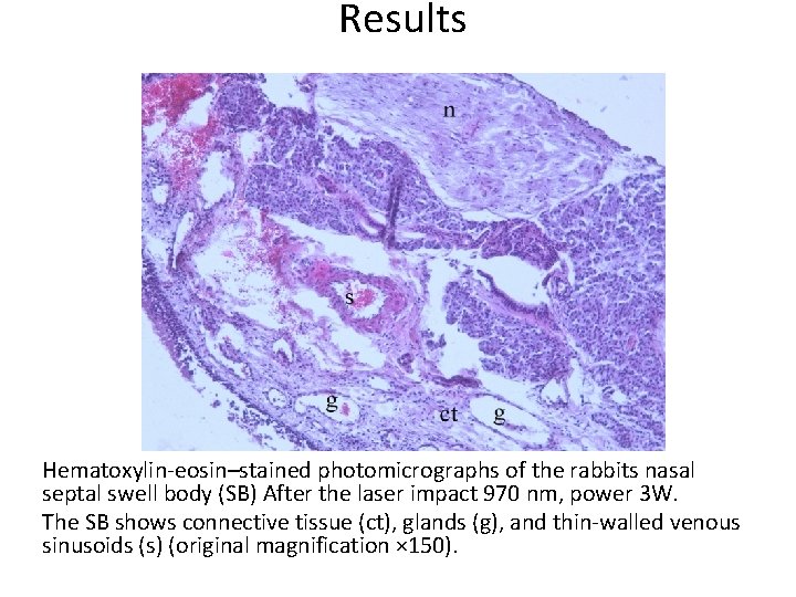 Results Hematoxylin-eosin–stained photomicrographs of the rabbits nasal septal swell body (SB) After the laser