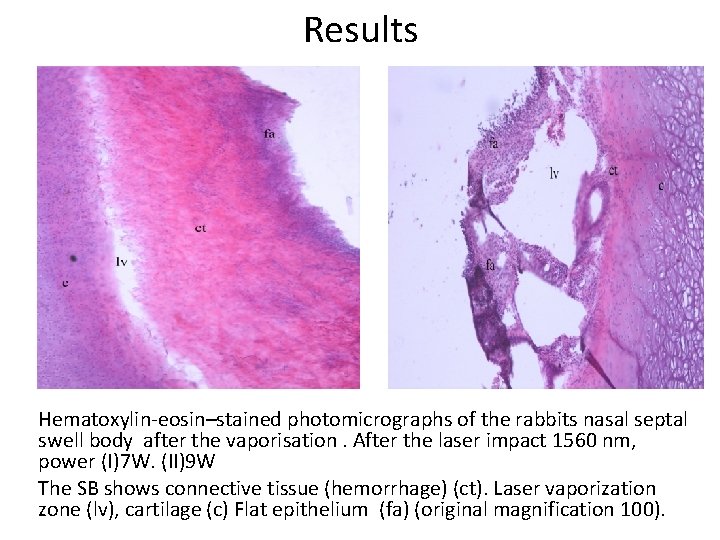 Results Hematoxylin-eosin–stained photomicrographs of the rabbits nasal septal swell body after the vaporisation. After