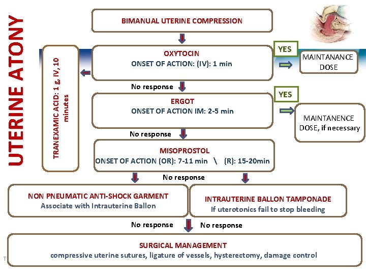 TRANEXAMIC ACID: 1 g, IV, 10 minutes UTERINE ATONY BIMANUAL UTERINE COMPRESSION OXYTOCIN ONSET