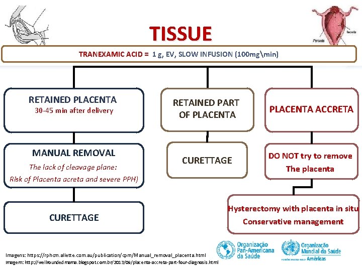 TISSUE TRANEXAMIC ACID = 1 g, EV, SLOW INFUSION (100 mgmin) TRANEXAMIC ACID =