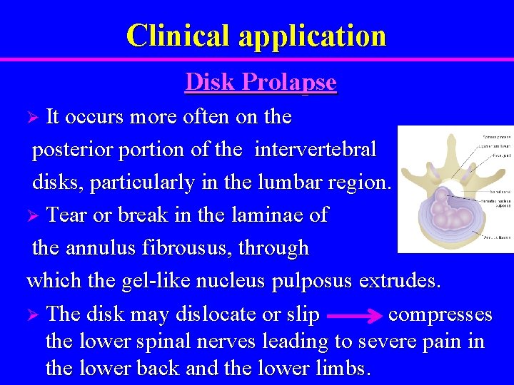 Clinical application Disk Prolapse Ø It occurs more often on the posterior portion of