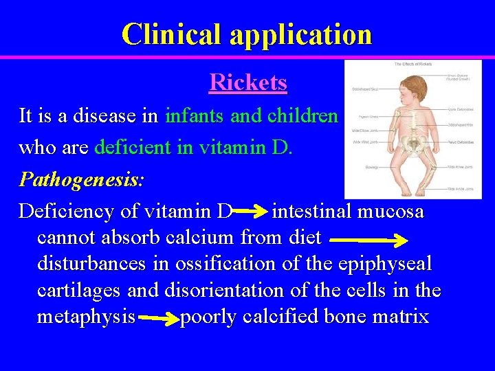 Clinical application Rickets It is a disease in infants and children who are deficient
