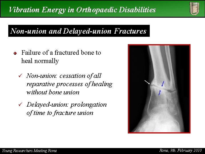 Vibration Energy in Orthopaedic Disabilities Non-union and Delayed-union Fractures Failure of a fractured bone