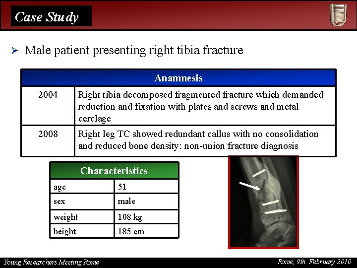 Case Study Ø Male patient presenting right tibia fracture Anamnesis 2004 Right tibia decomposed